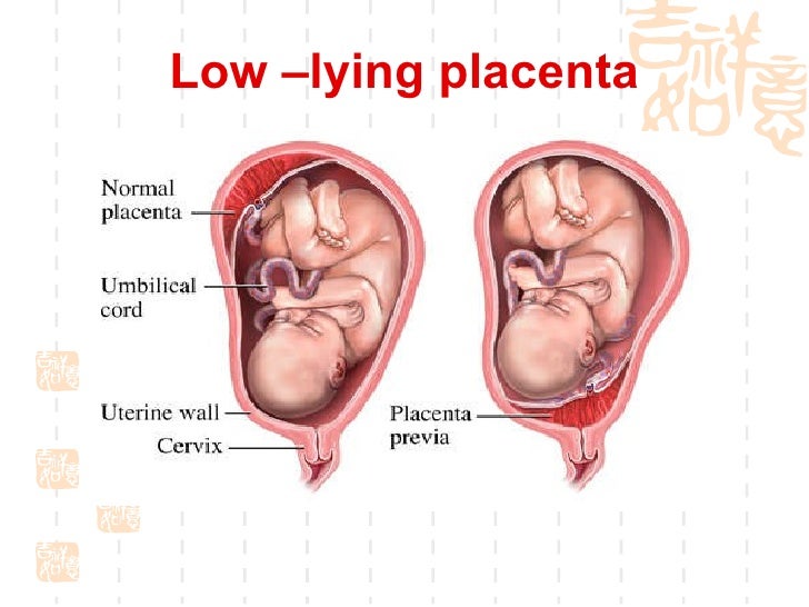 POTUS reccomend Orgasm with low-lying placenta