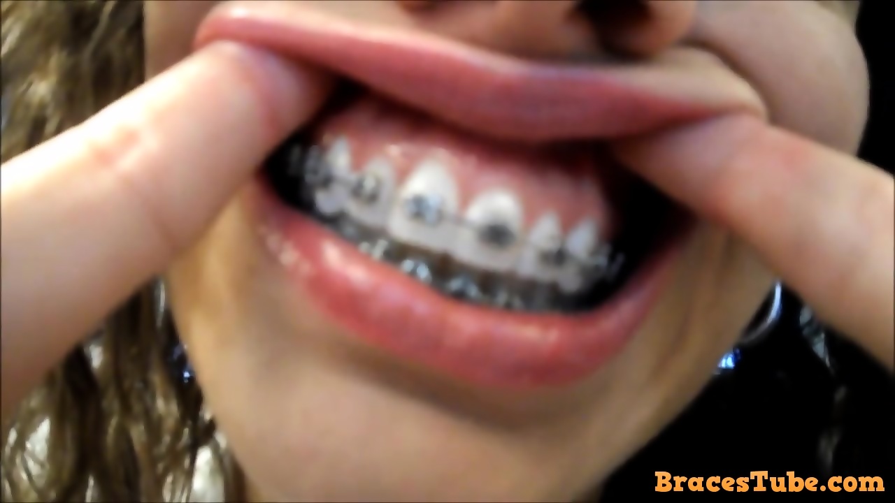 best of Exam tour mouth braces