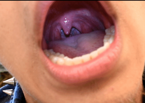 Laser reccomend showing uvula while braces