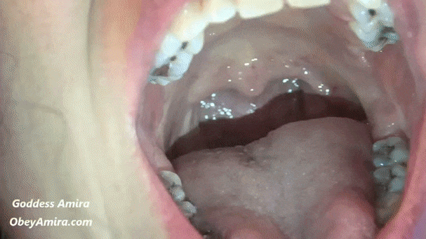 Showing uvula while braces
