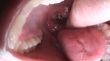Brambleberry reccomend having torturing uvula