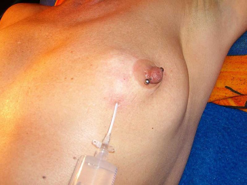 Saline infusion breast